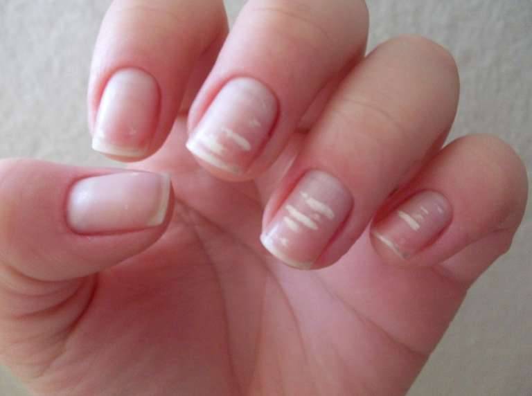 Why do i have white spots in my fingernails? | zocdoc answers