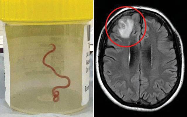 Doctors remove 3-inch parasitic worm from woman’s brain in world first