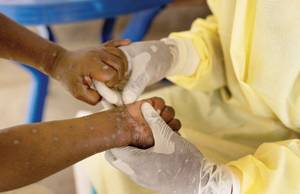 First case of more contagious mpox found outside Africa