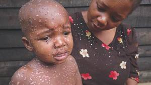 Children bearing the brunt of mpox outbreak in Congo