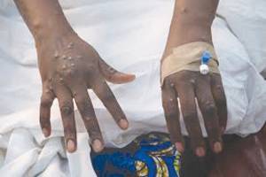 Almost 30,000 suspected mpox cases in Africa this year, says WHO