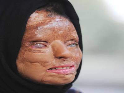 Acid attack victim (18) makes bold statement in Youtube 