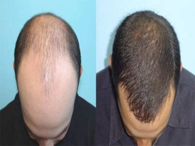 Scientists Use Drug To Regrow Bald Man S Hair